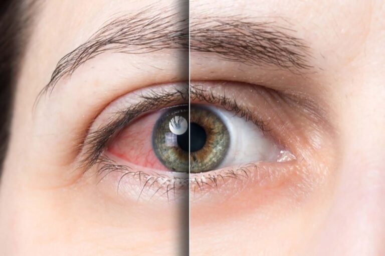 خشکی چشم چگونه بینایی را کاهش می‌دهد؟
