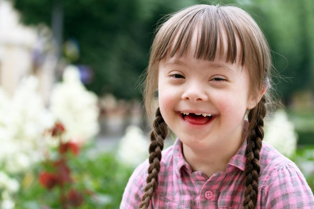 اختلال سندرم داون