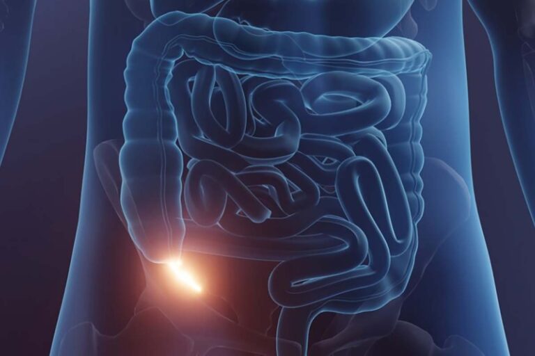 همه چیز درباره آپاندیس و علائم آپاندیسیت