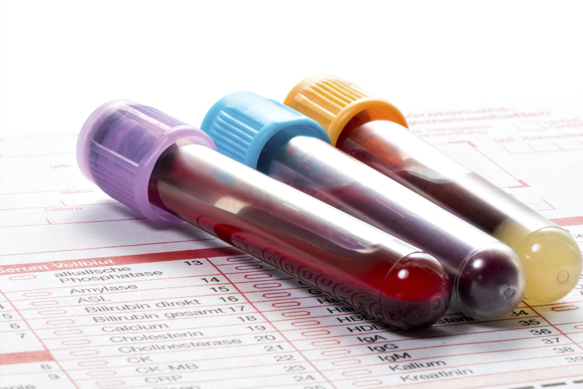  نقش آزمایش خون در ارزیابی و مدیریت بیماری قلبی چیست؟