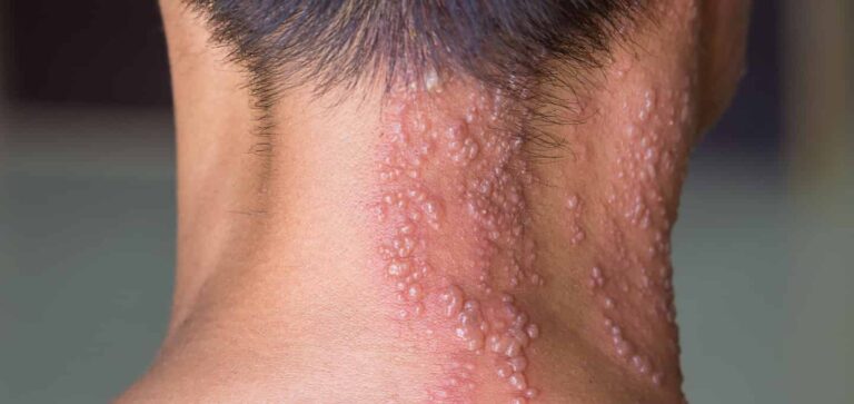 بیماری زونا چیست؟