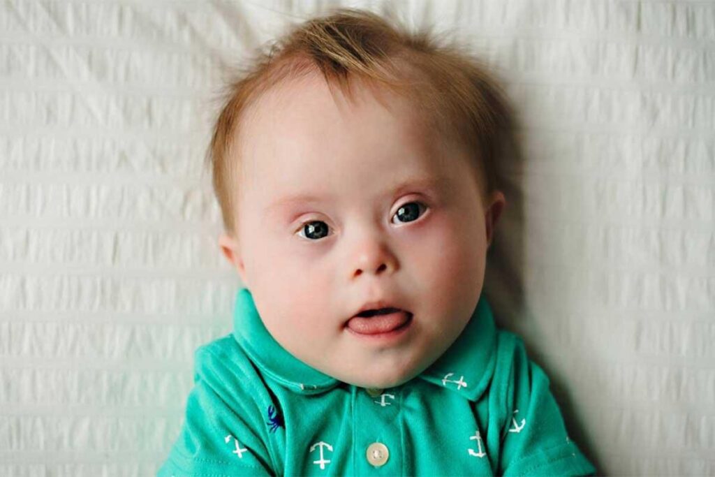 سندرم داون