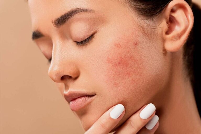 جوش زیر پوستی را چگونه از بین ببریم؟