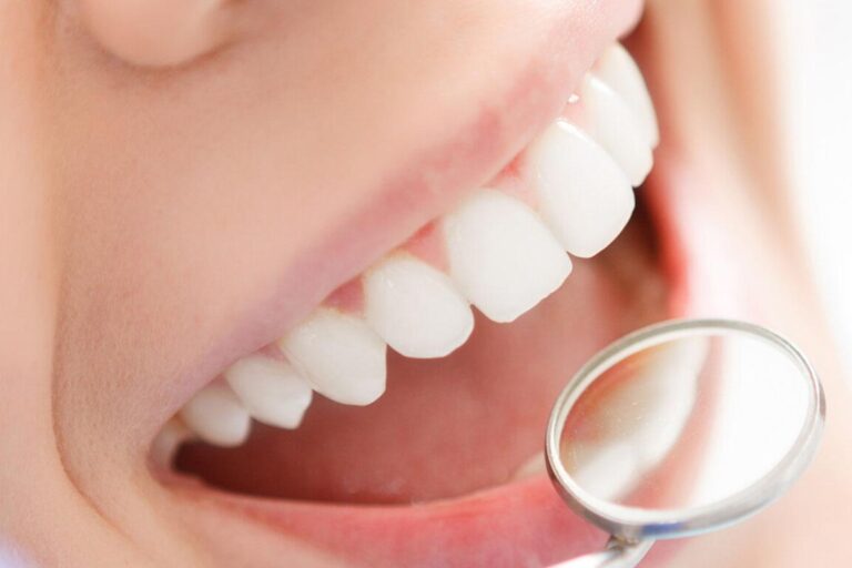 لمینت دندان چیست؟ مزایا و معایب آن