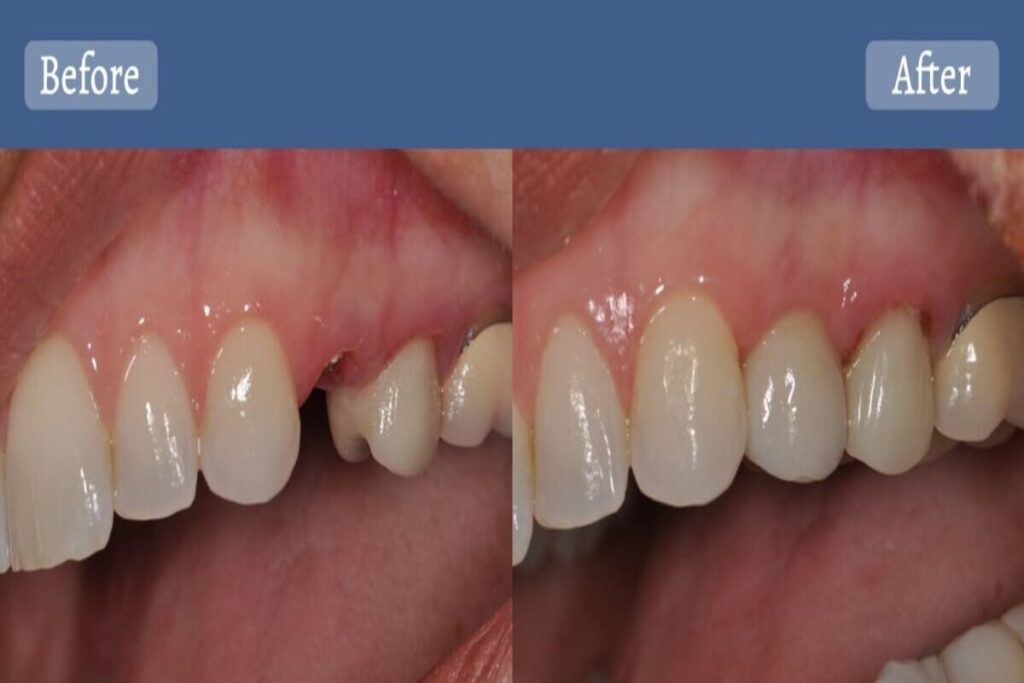 نمونه ایمپلنت دندان