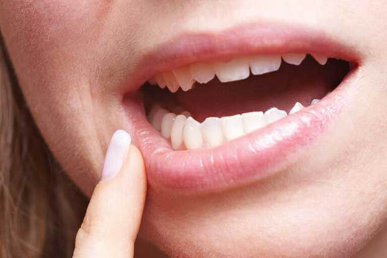 آفت دهان و روش های درمان خانگی و دارویی