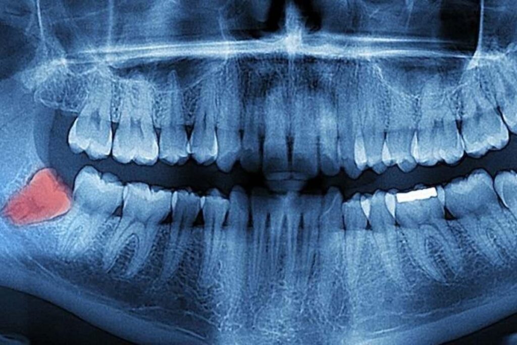علائم آبسه دندان عقل