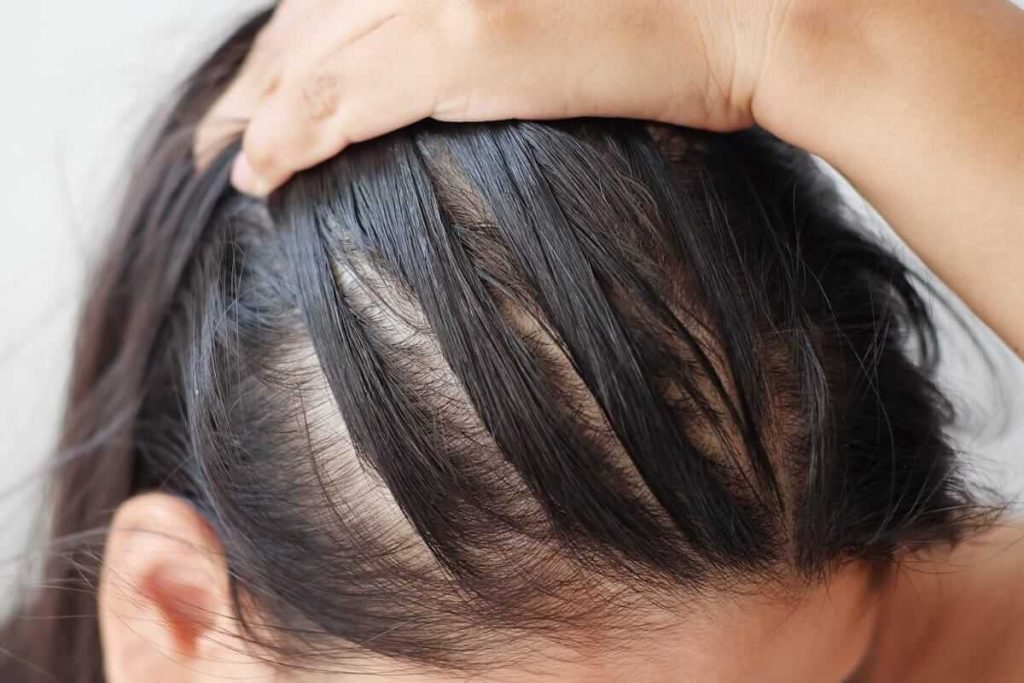 علت ریزش مو در زنان بالای ۴۰ سال