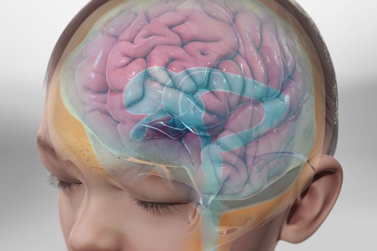 همه چیز درباره هیدروسفالی؛ علائم، علل و درمان آن