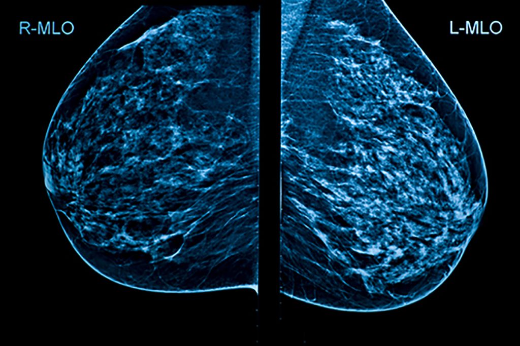 عکس ماموگرافی سرطانی