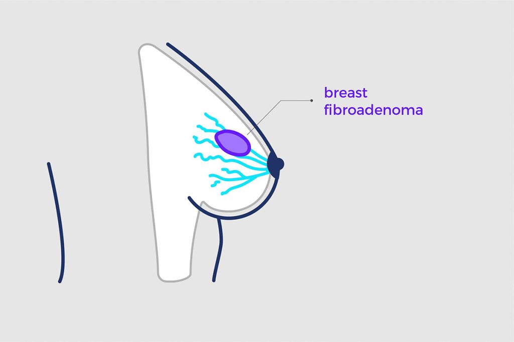 علت فیبروآدنوم پستانی