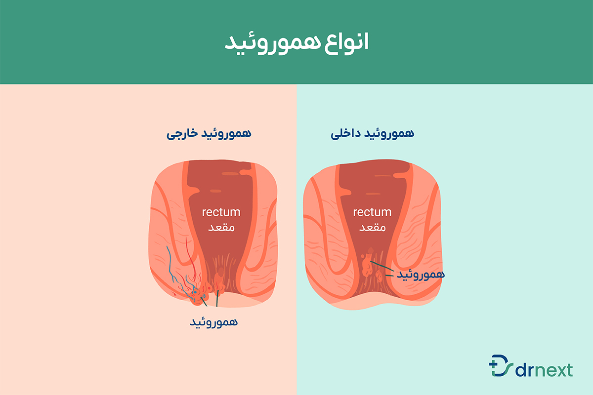 انواع هموروئید