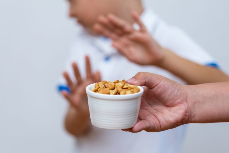 چگونه حساسیت به آجیل را تشخیص دهیم؟